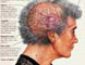 Alzheimer's Disease Acupuncture Herbal Medicine Treatment Cure Articles, Submit Alzheimer's Disease Acupuncture Herbal Medicine Treatment Cure Articles