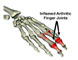 Rheumatism Arthritis Acupuncture Herbal Medicine Treatment Cure Articles, Submit Rheumatism Arthritis Acupuncture Herbal Medicine Treatment Cure Articles